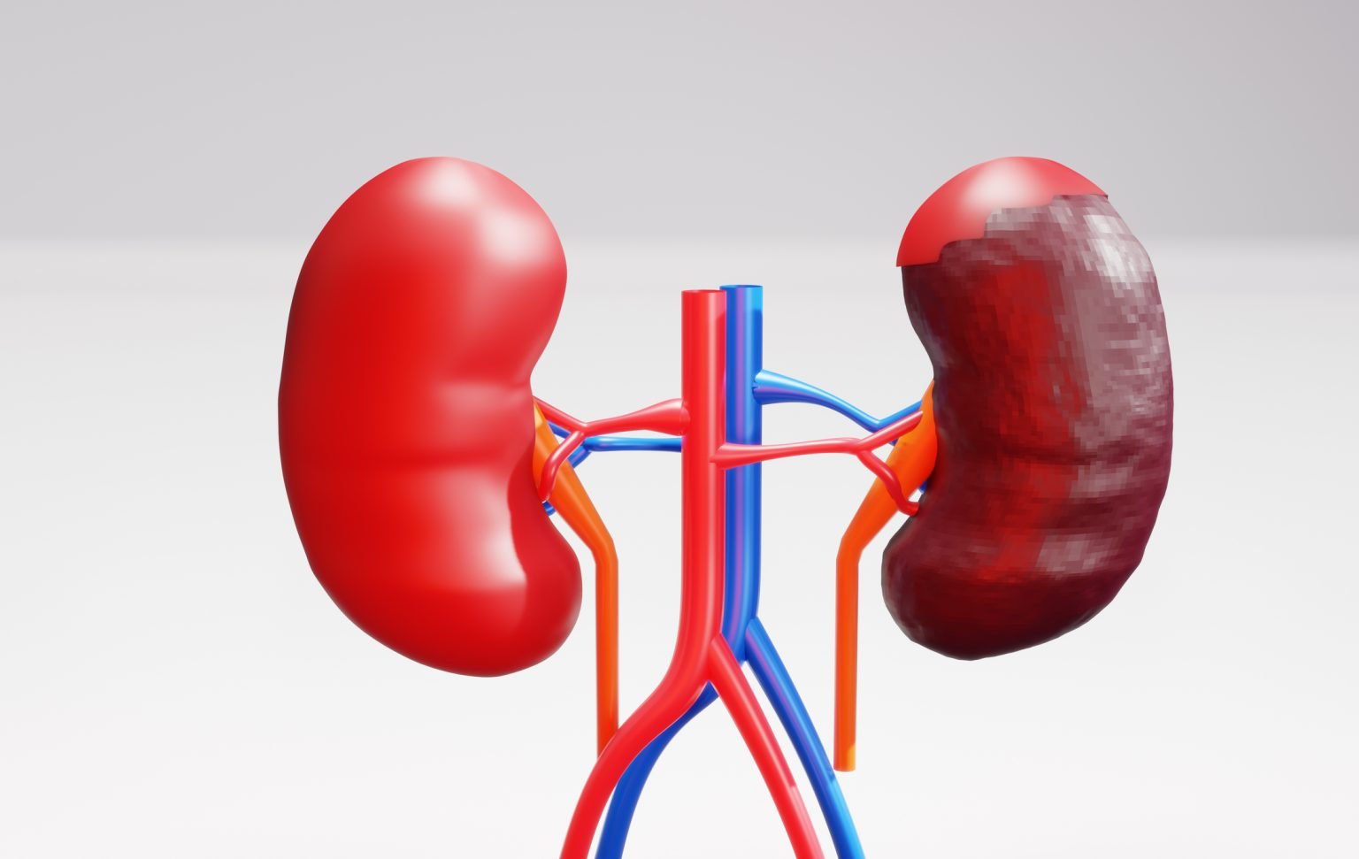 New Method of Treating Kidney Cancer Discovered by Scientists