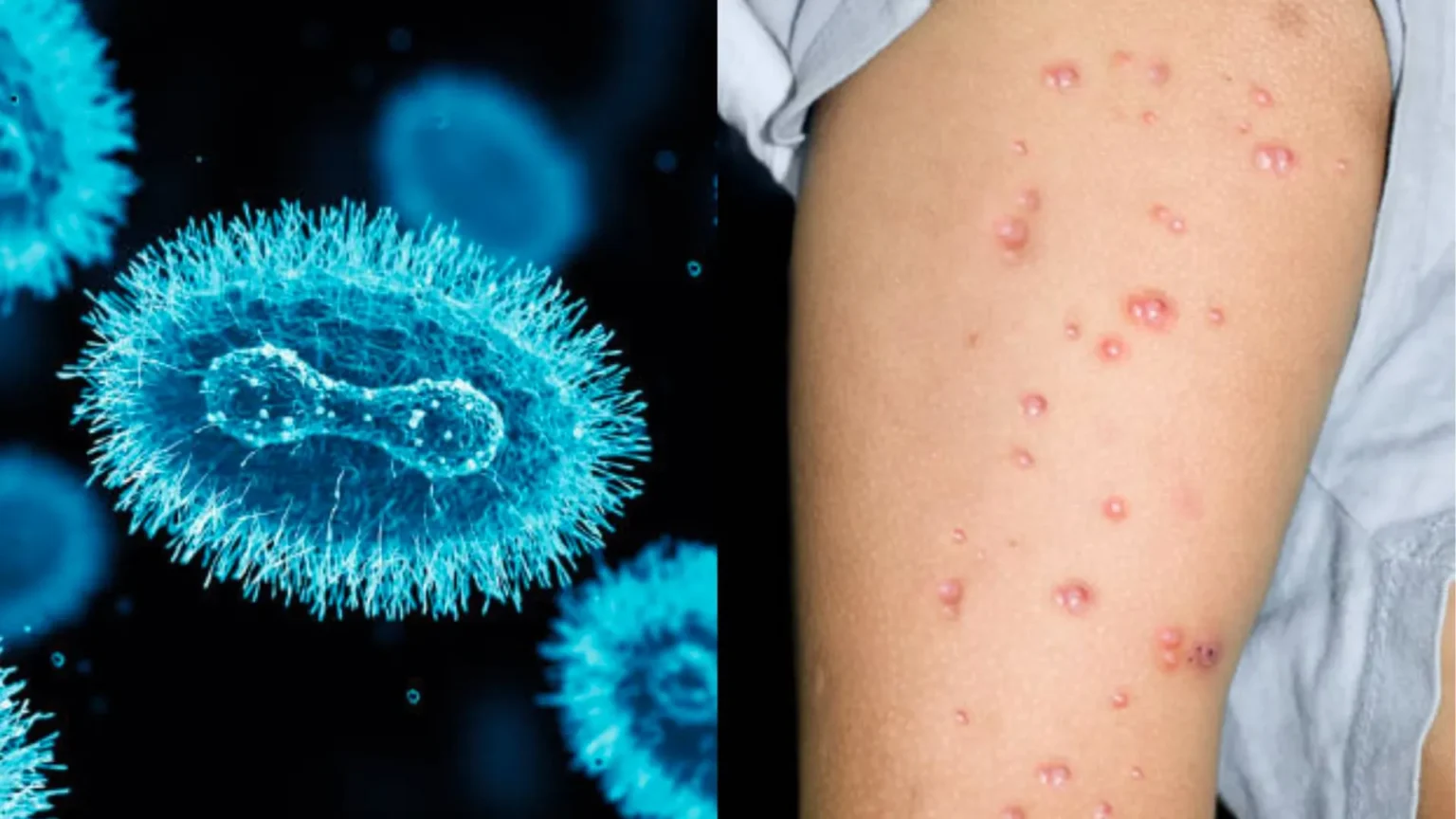 22,000 mpox cases registered in Africa in 2024